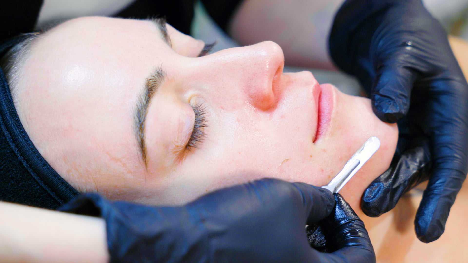 Dermaplaning