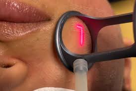 Laser CO2 Fractional RF Technician training at BC Medical Aesthetic