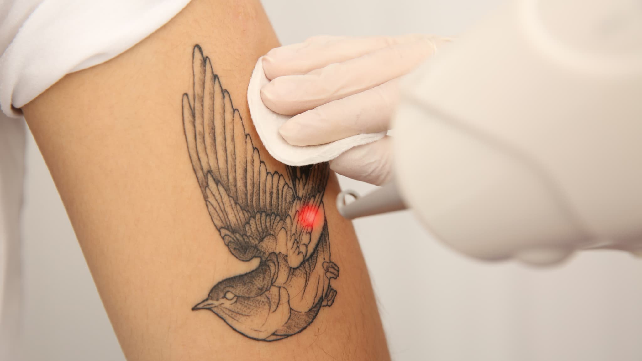 Laser Tattoo Removal treatment at BC Medical Aesthetic