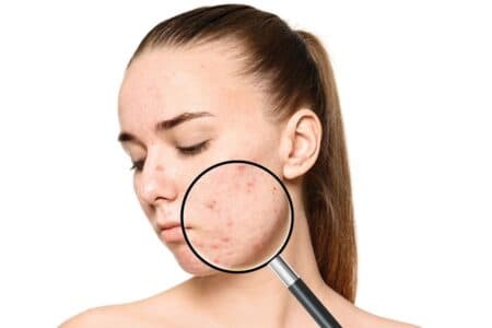 Acne Treatment in Coquitlam & Vancouver: Professional Options That Actually Work